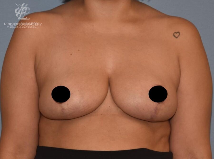 Breast Reduction, patient 6, after, view 1