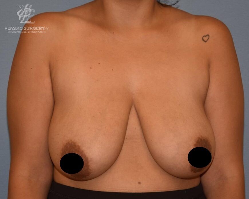 Breast Reduction, patient 6, before, view 1