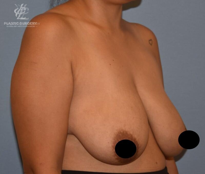 Breast Reduction, patient 6, before, view 2
