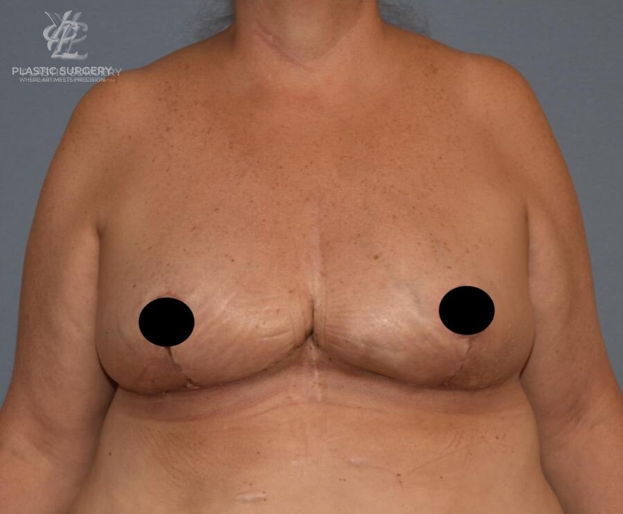 Breast Reduction, patient 8, after, view 1