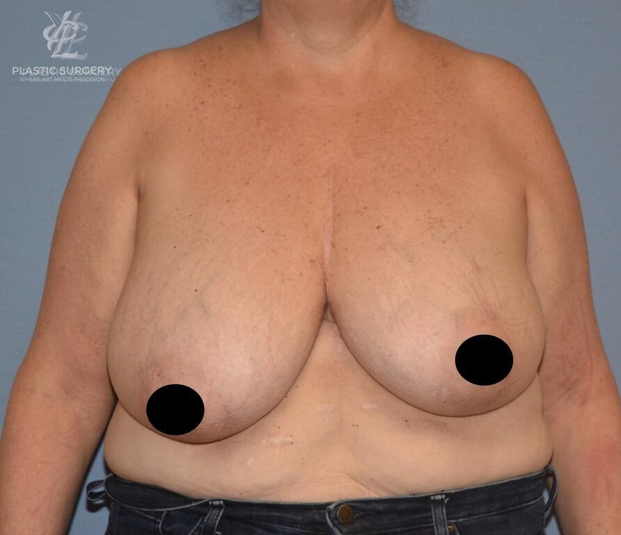 Breast Reduction, patient 8, before, view 1