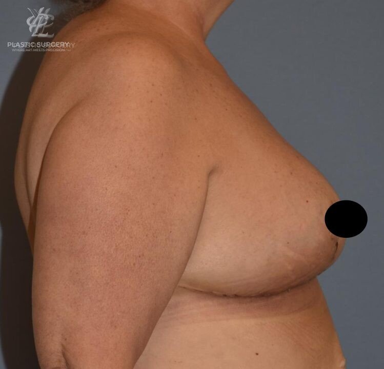 Breast Reduction, patient 8, after, view 3