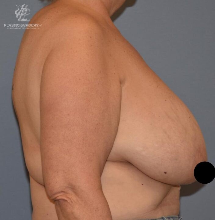 Breast Reduction, patient 8, before, view 3