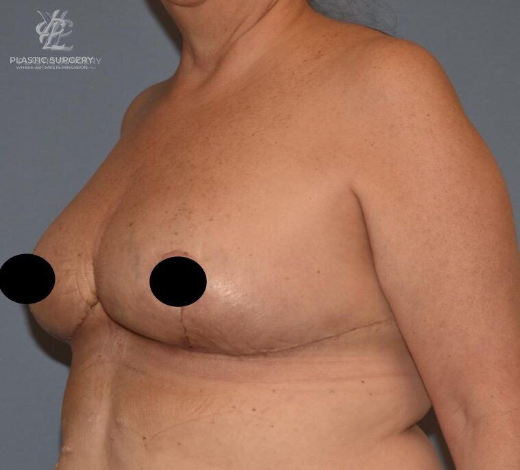 Breast Reduction, patient 8, after, view 2