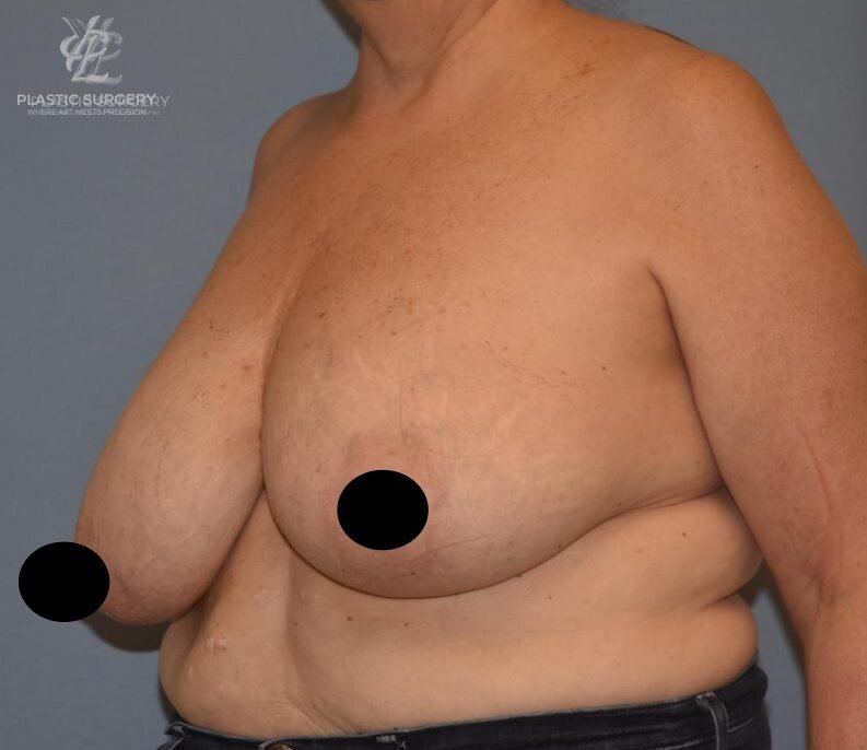 Breast Reduction, patient 8, before, view 2