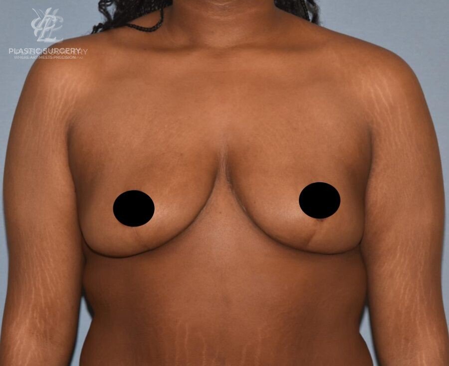Breast Reduction, patient 9, after, view 1