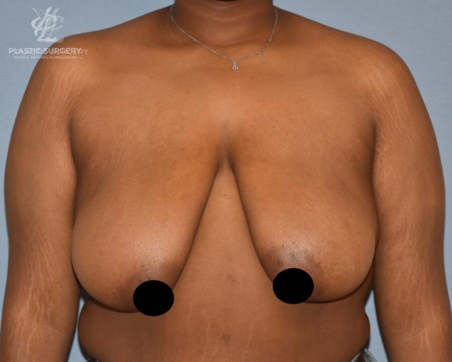 Breast Reduction, patient 9, before, view 1