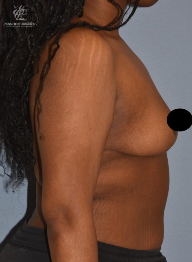 Breast Reduction, patient 9, after, view 3