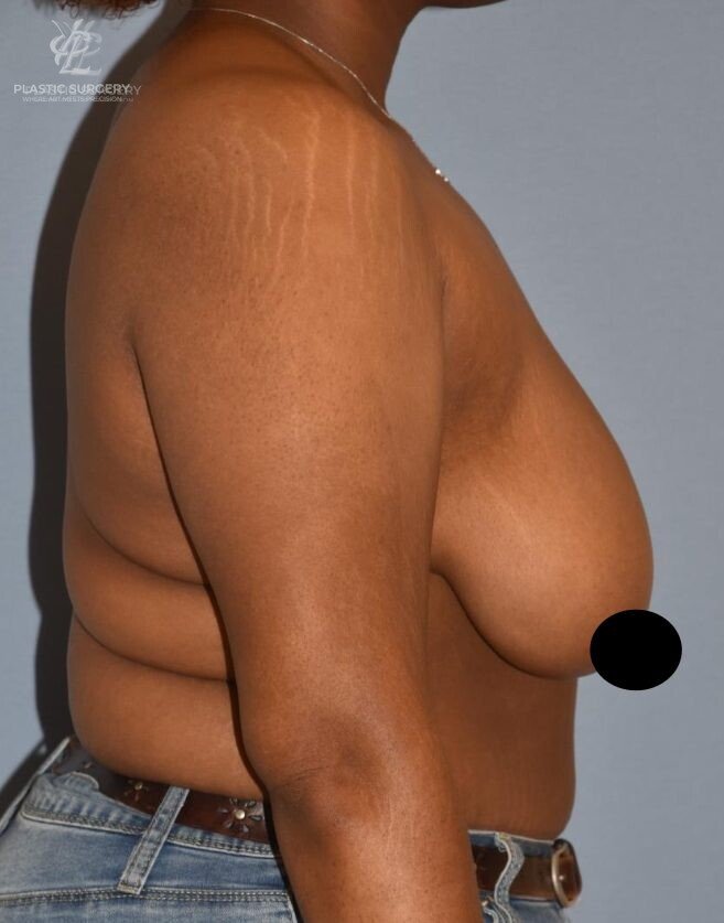 Breast Reduction, patient 9, before, view 3