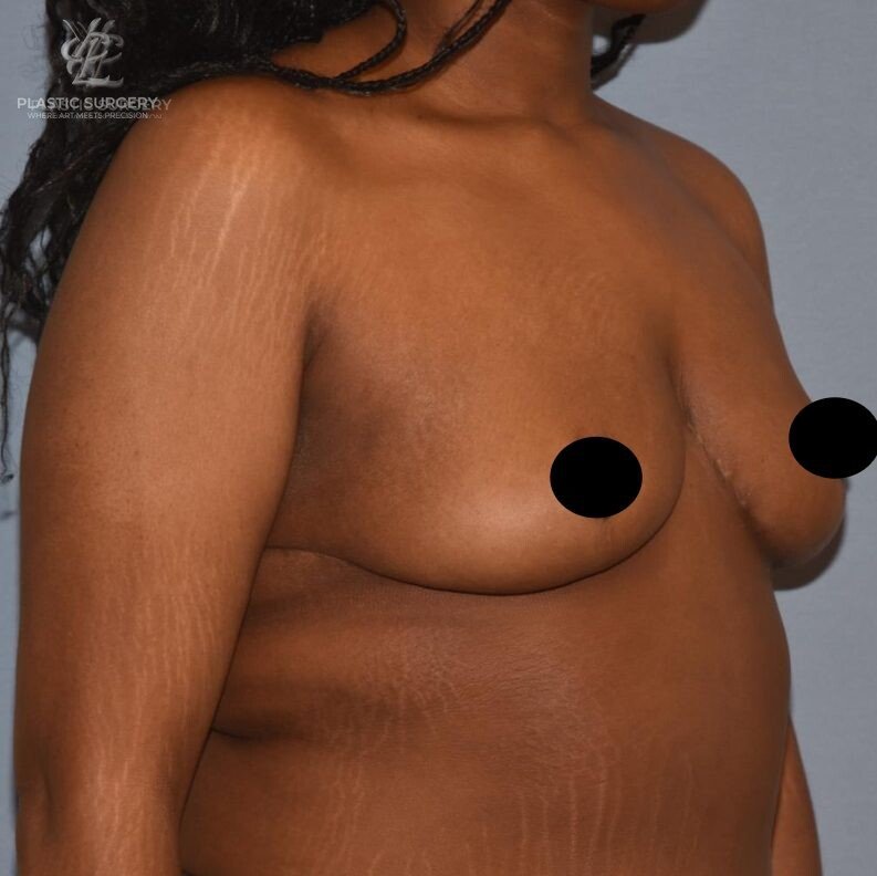 Breast Reduction, patient 9, after, view 2