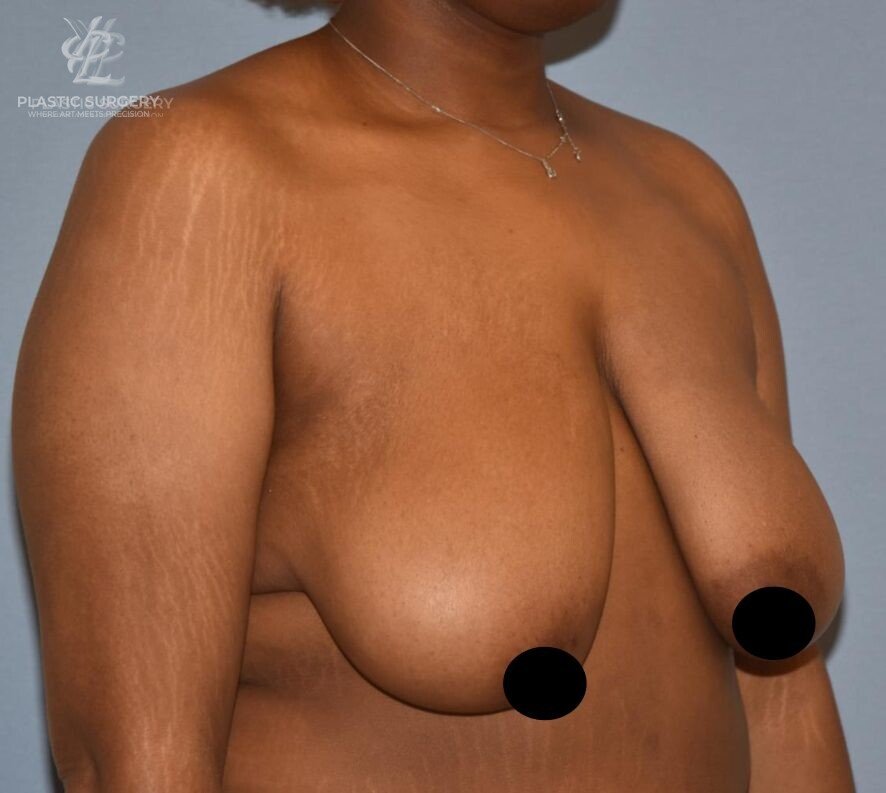Breast Reduction, patient 9, before, view 2