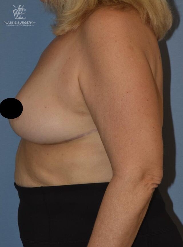 Breast Reduction, patient 10, after, view 3