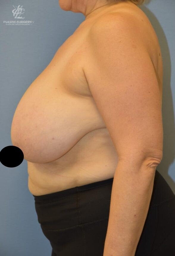 Breast Reduction, patient 10, before, view 3