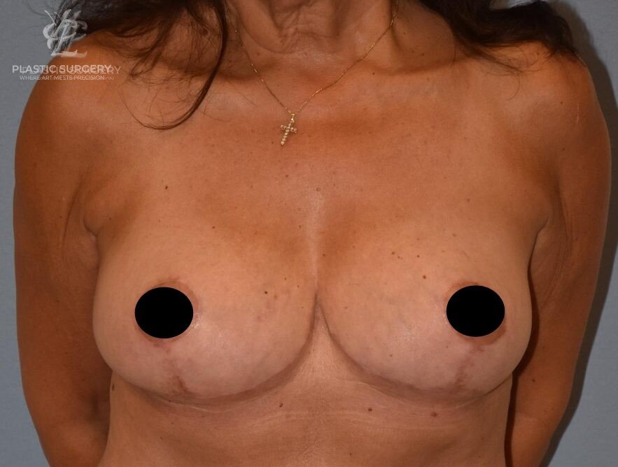 Breast Reduction, patient 11, after, view 1