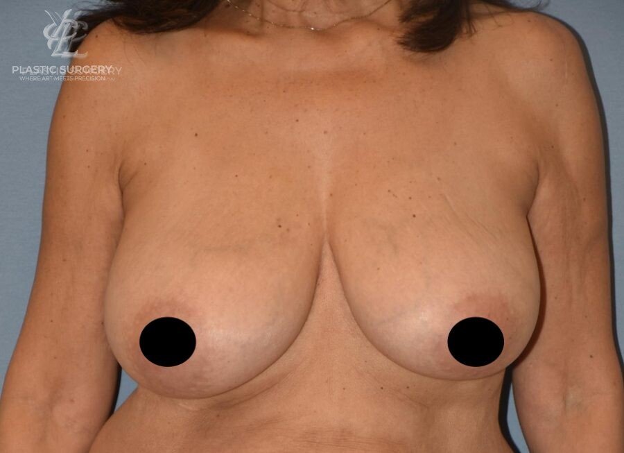 Breast Reduction, patient 11, before, view 1