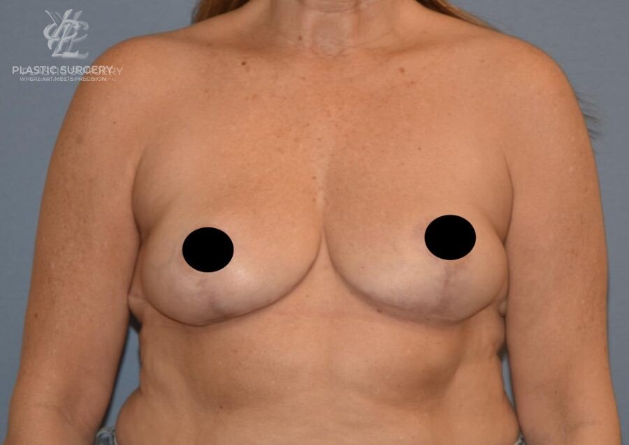 Breast Reduction, patient 12, after, view 1