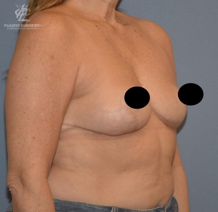 Breast Reduction, patient 12, after, view 2