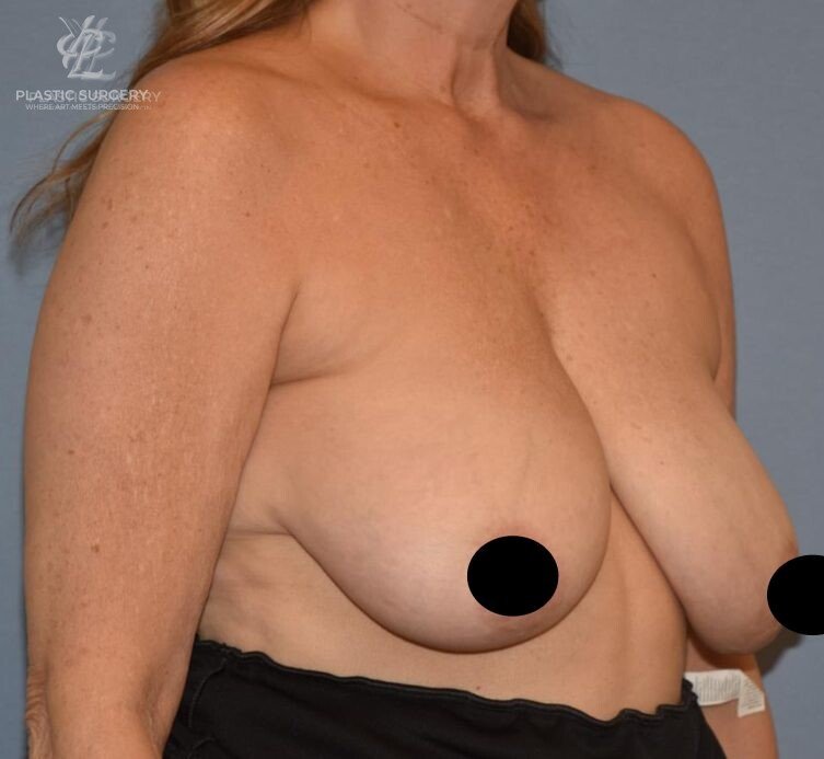 Breast Reduction, patient 12, before, view 2