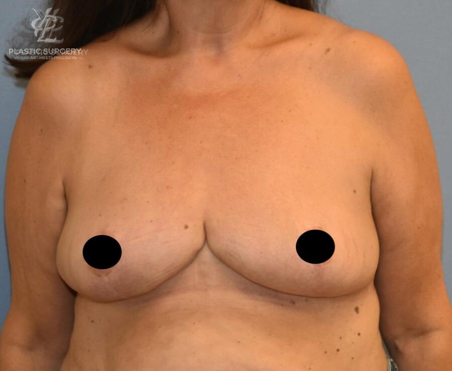 Breast Reduction, patient 14, after, view 1