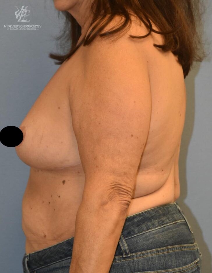 Breast Reduction, patient 14, after, view 3