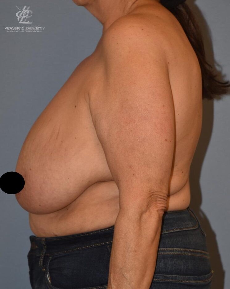 Breast Reduction, patient 14, before, view 3