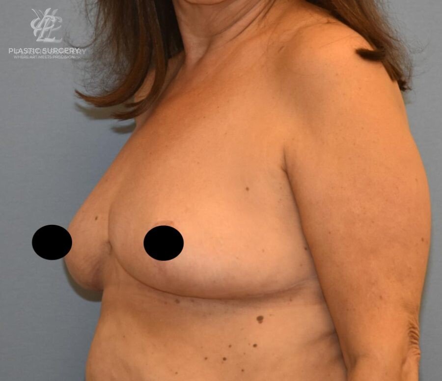 Breast Reduction, patient 14, after, view 2