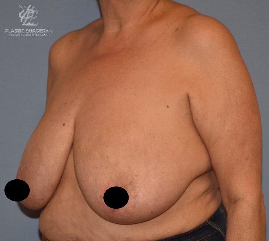 Breast Reduction, patient 14, before, view 2