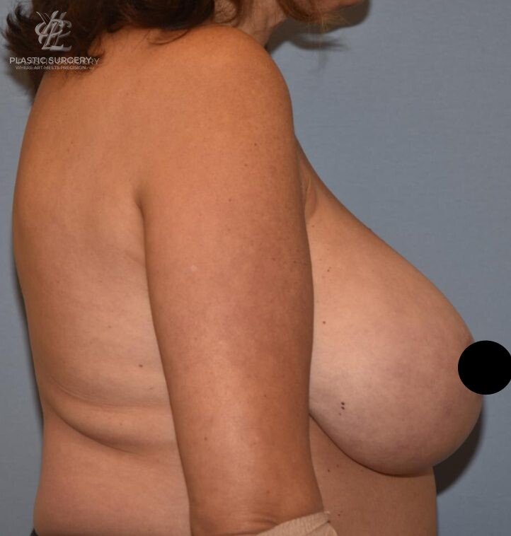 Breast Reduction, patient 15, before, view 3
