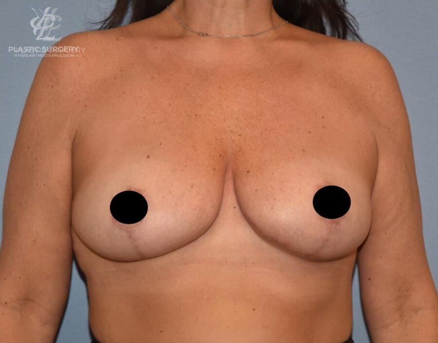 Breast Reduction, patient 16, after, view 1
