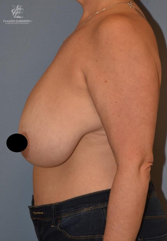 Breast Reduction, patient 16, before, view 3