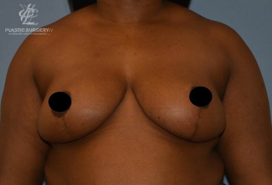 Breast Reduction, patient 17, after, view 1