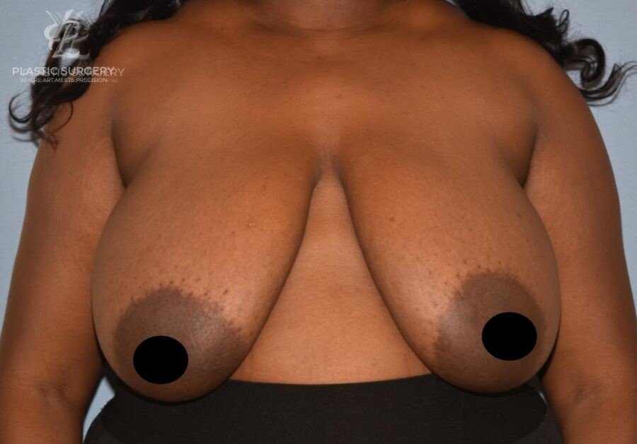 Breast Reduction, patient 17, before, view 1