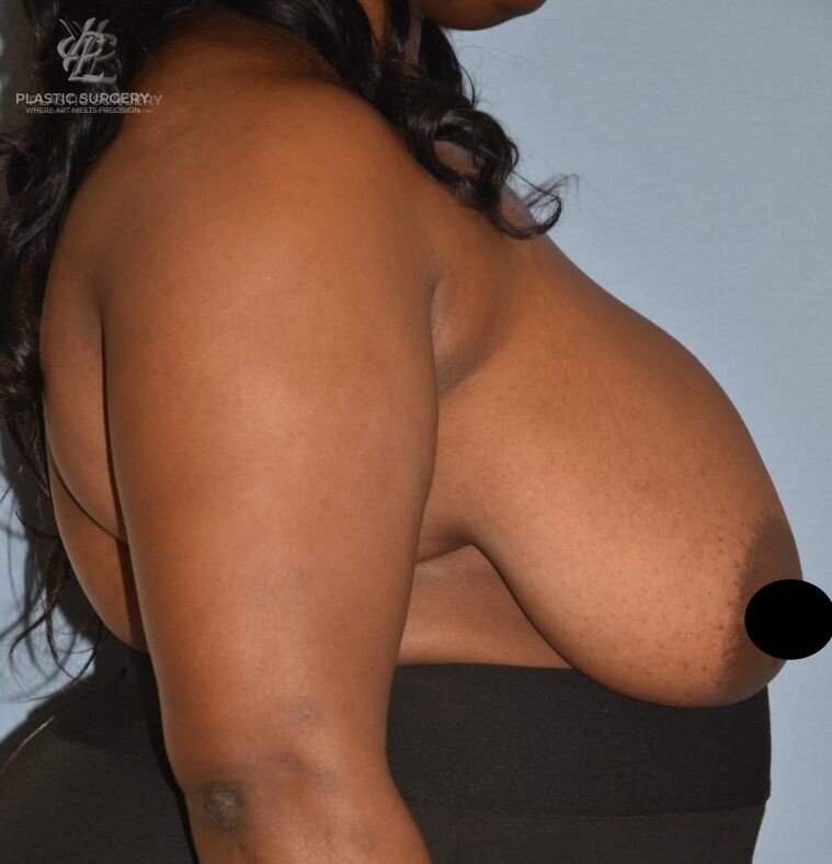Breast Reduction, patient 17, before, view 3