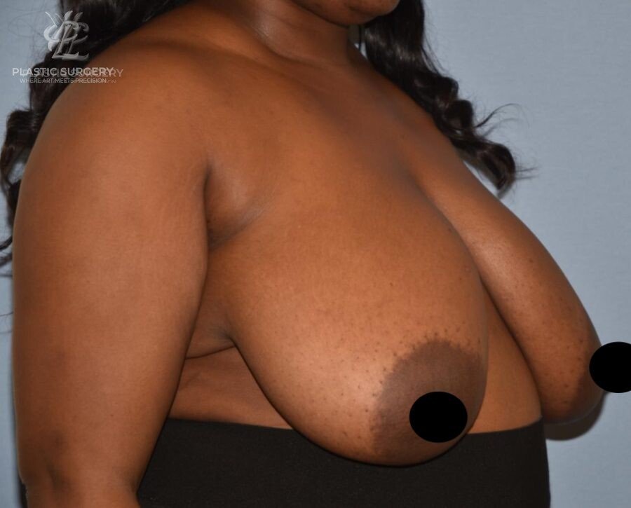 Breast Reduction, patient 17, before, view 2