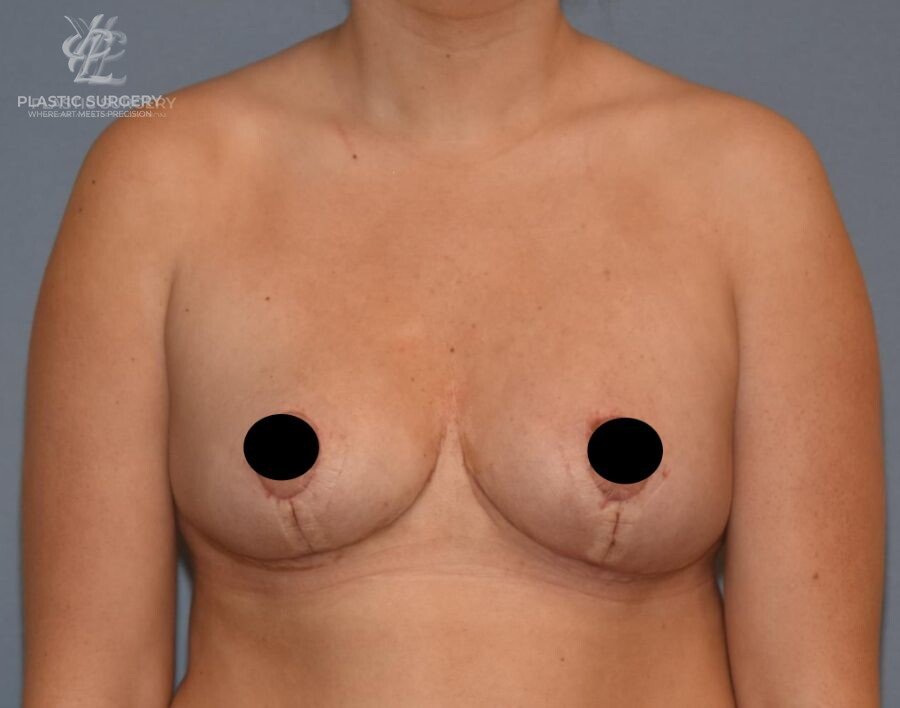 Breast Reduction, patient 18, after, view 1
