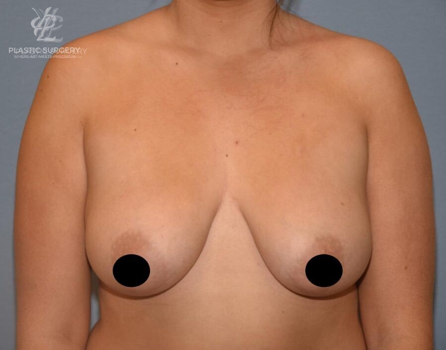 Breast Reduction, patient 18, before, view 1