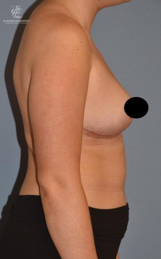 Breast Reduction, patient 18, after, view 3