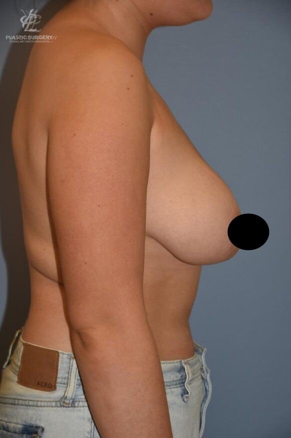 Breast Reduction, patient 18, before, view 3