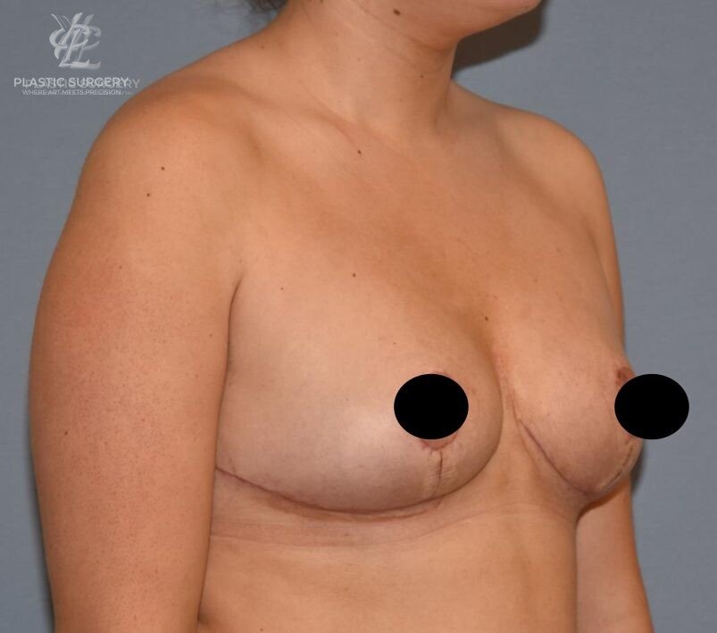 Breast Reduction, patient 18, after, view 2