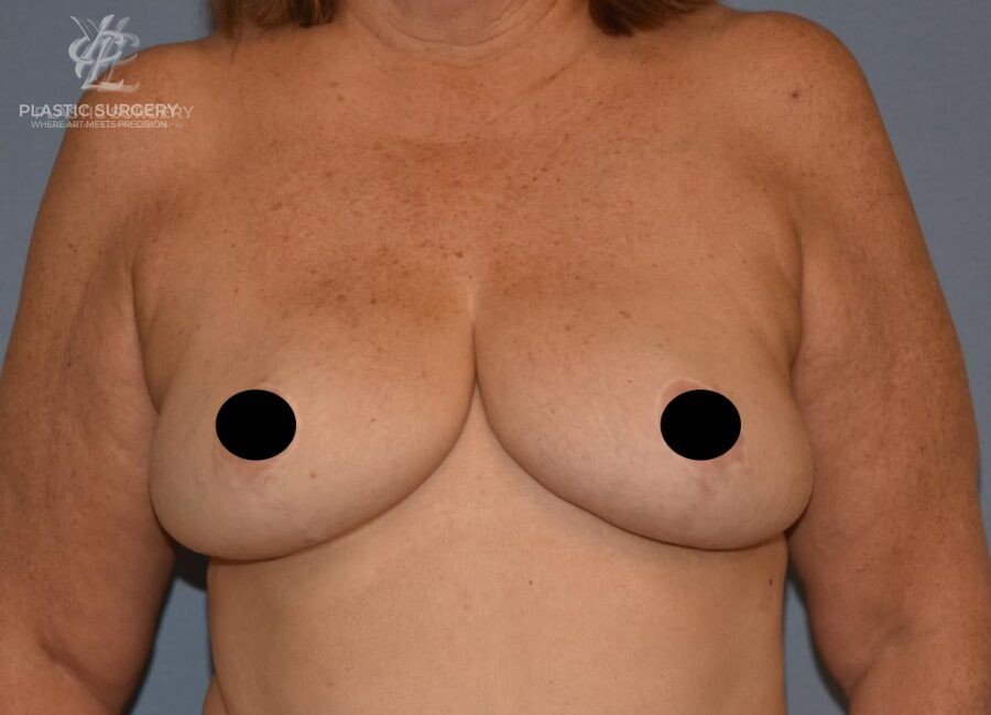 Breast Reduction, patient 19, after, view 1