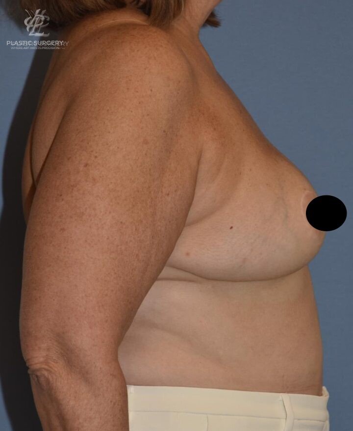 Breast Reduction, patient 19, after, view 3