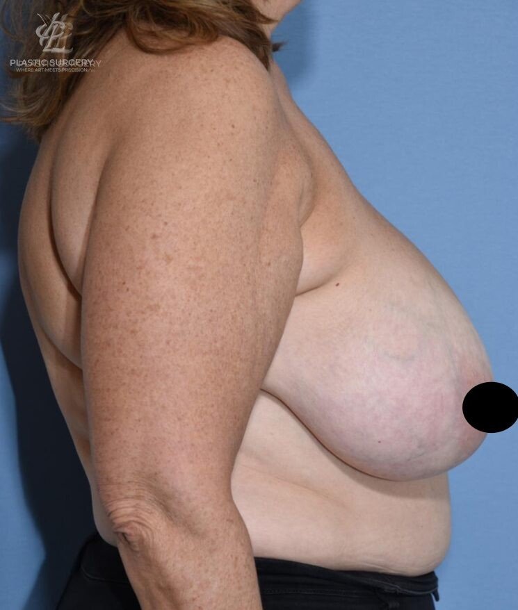 Breast Reduction, patient 19, before, view 3