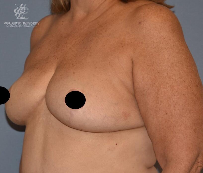 Breast Reduction, patient 19, after, view 2