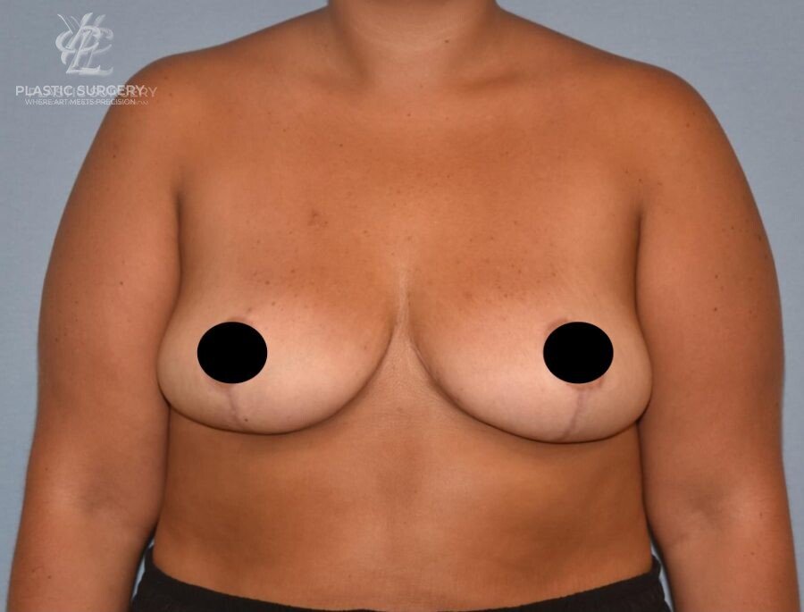 Breast Reduction, patient 20, after, view 1