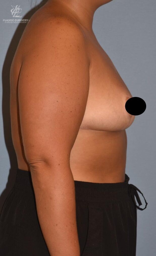 Breast Reduction, patient 20, after, view 3