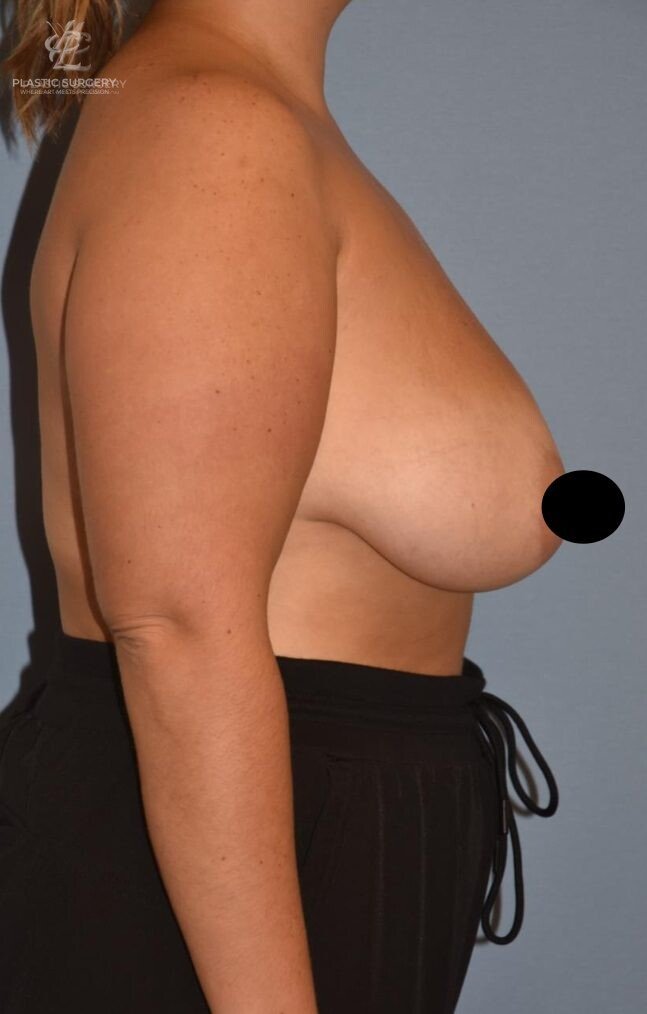 Breast Reduction, patient 20, before, view 3