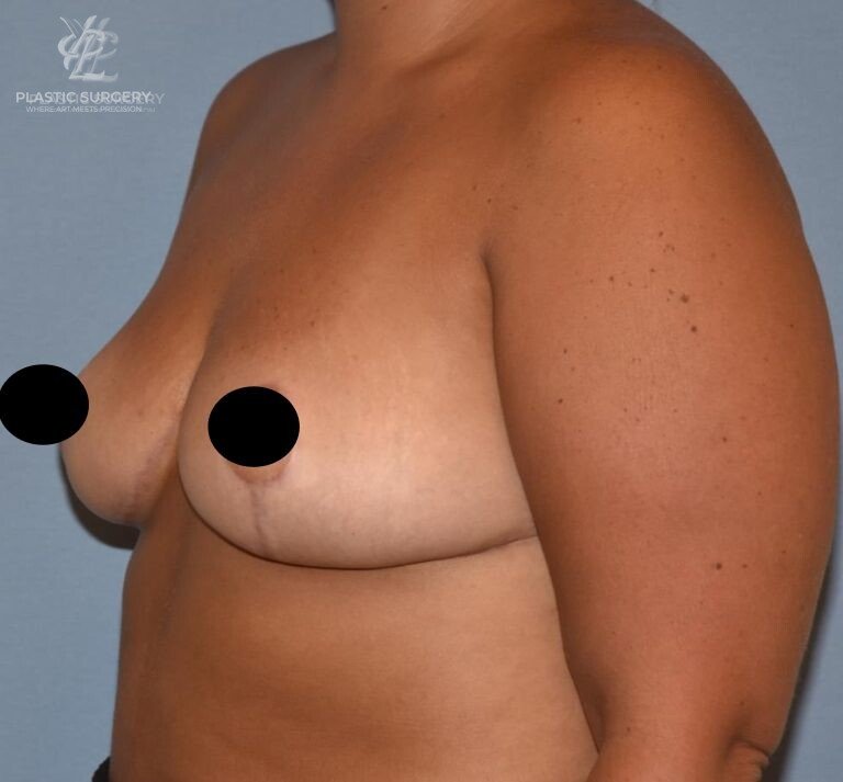Breast Reduction, patient 20, after, view 2