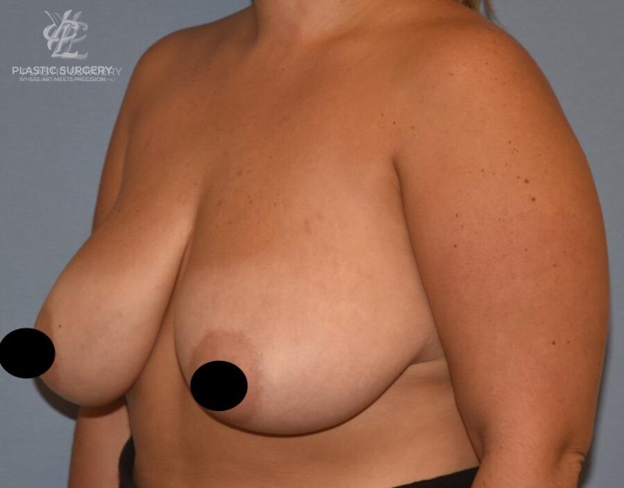 Breast Reduction, patient 20, before, view 2