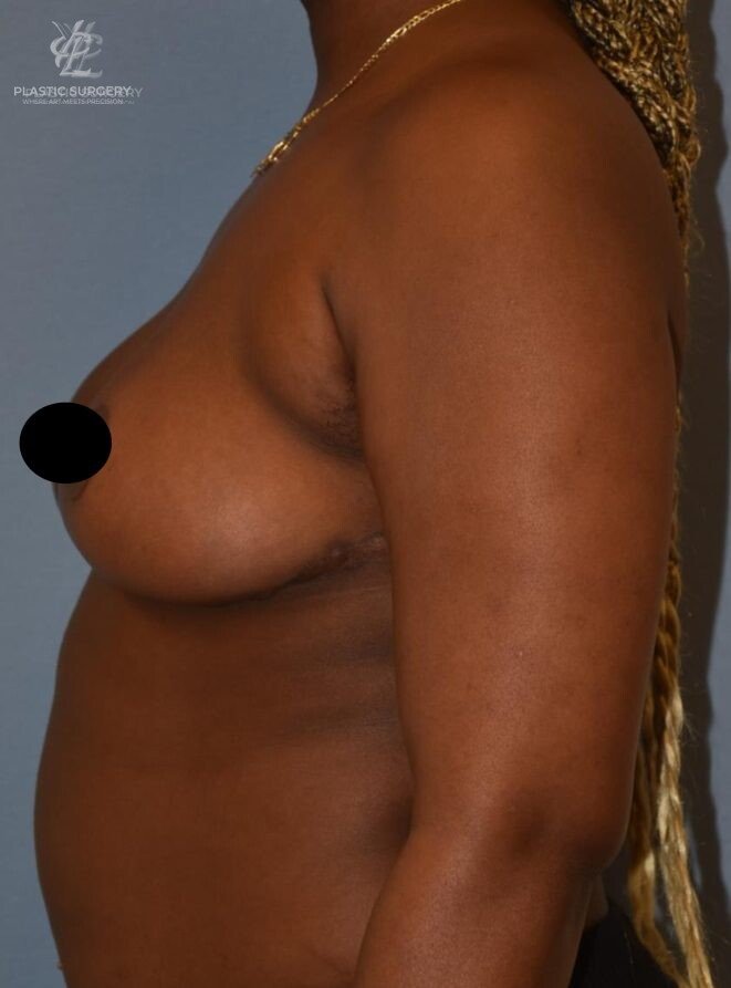 Breast Reduction, patient 21, after, view 3