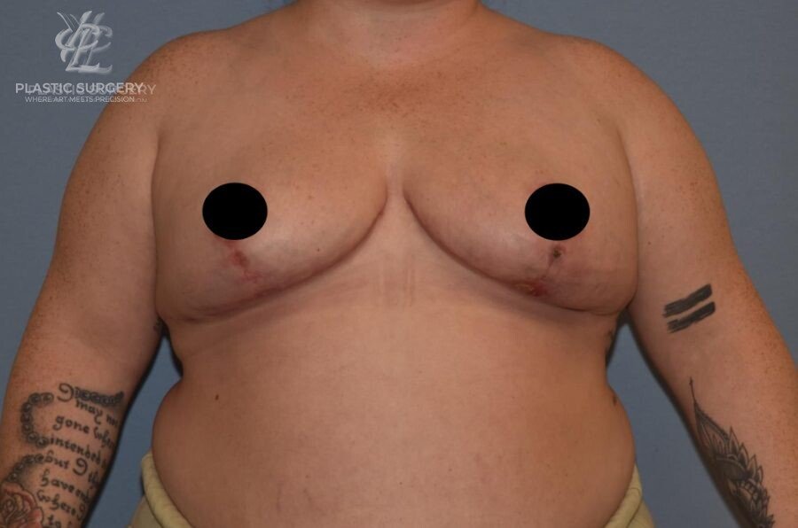 Breast Reduction, patient 22, after, view 1